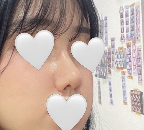 유원장님께 코수술받은지 네달차!