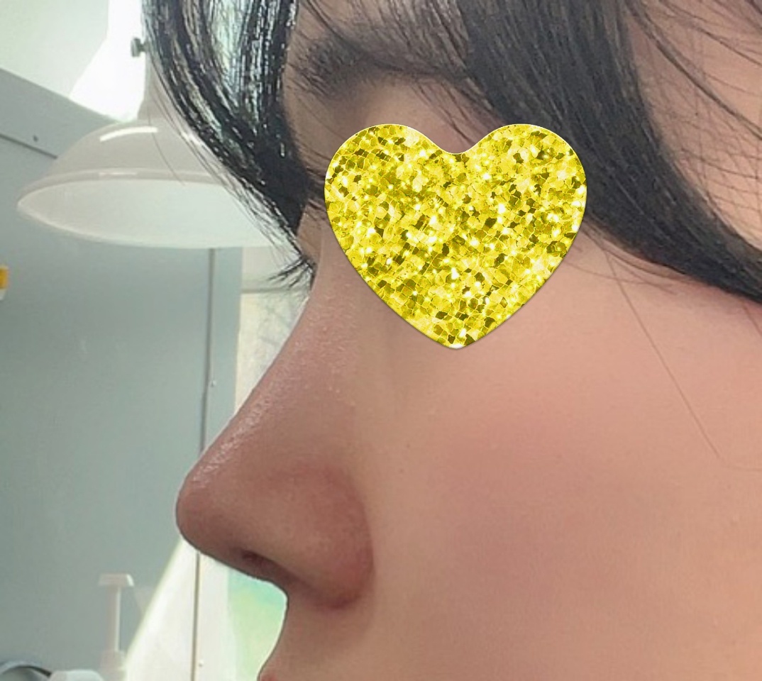 무보형물코&눈밑지방재배치 리얼후깅