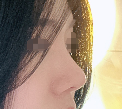 코성형, 눈밑지방재배치하고 4개월지났어요~~~