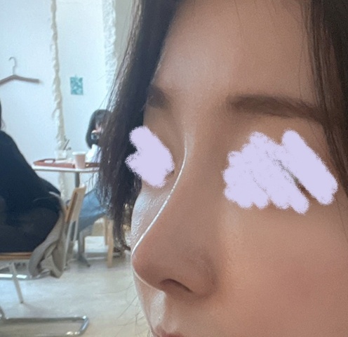 매부리코 무보형물 코성형! 넘 만족해용