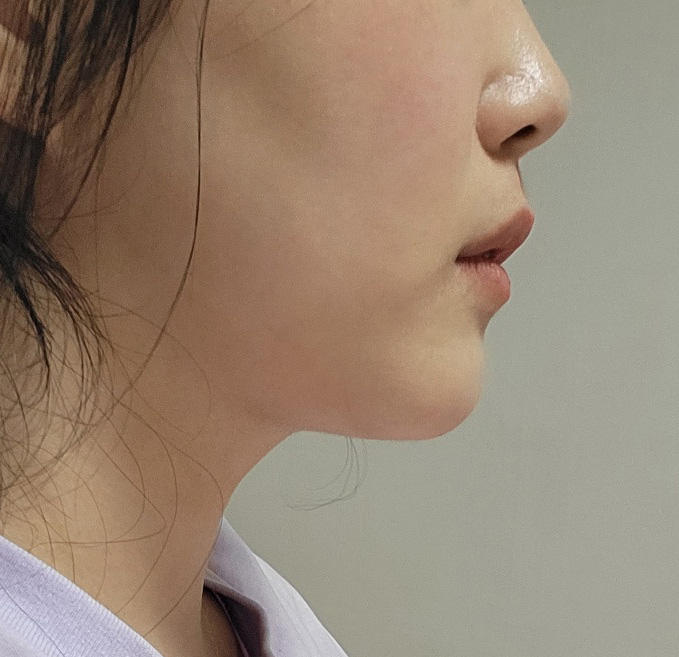 턱살고민 바이브에서 해결한 후기ㅎㅎ