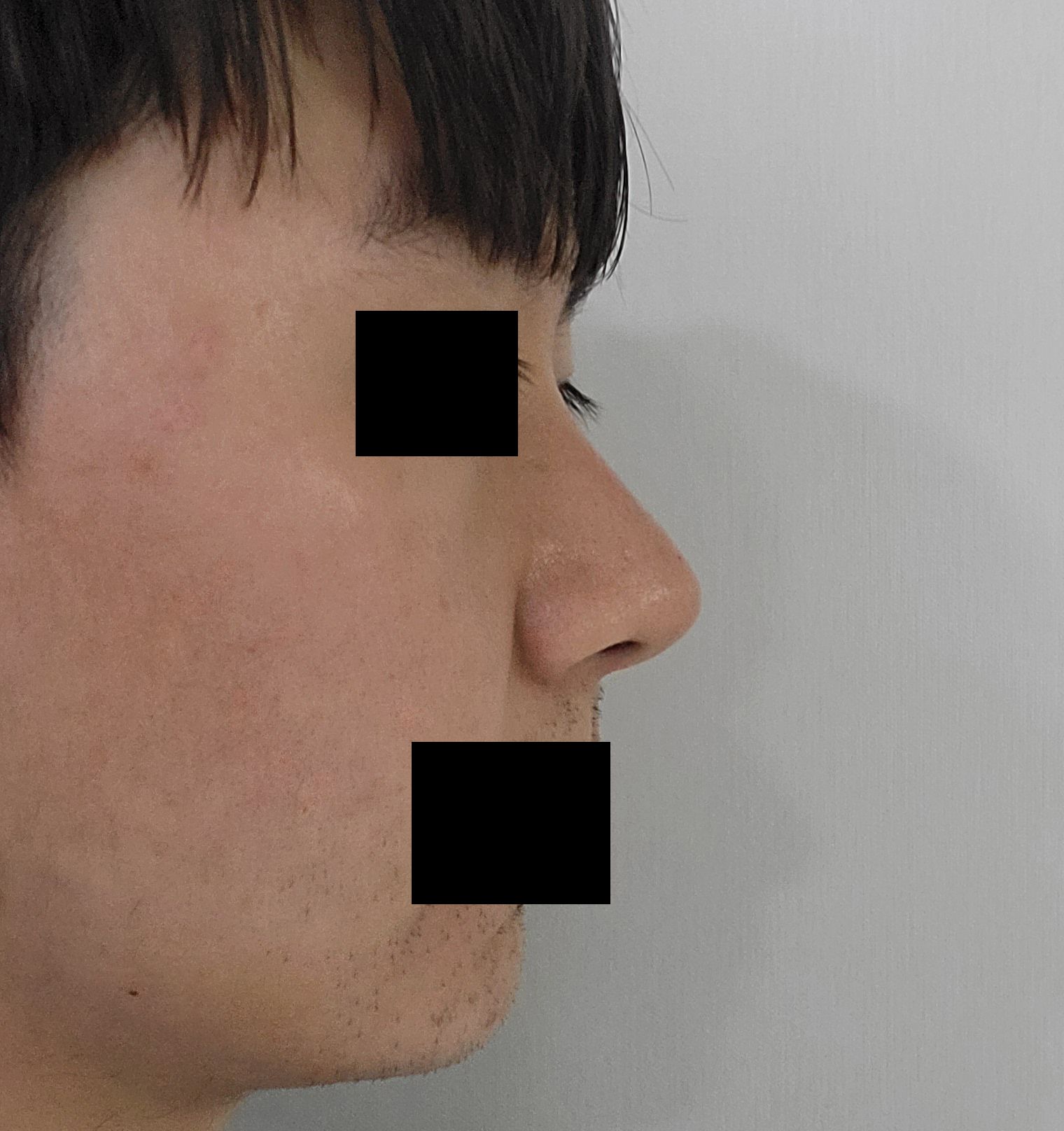 코, 지방흡입,심부볼제거, 보톡스 4개월 됐어요