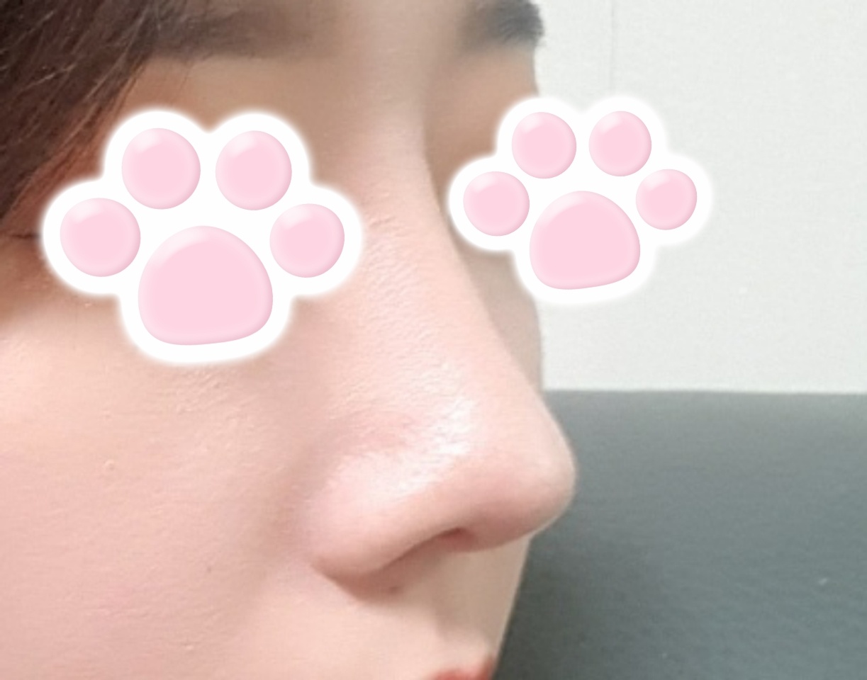 코재수술 고민하시면 바이브 추천!