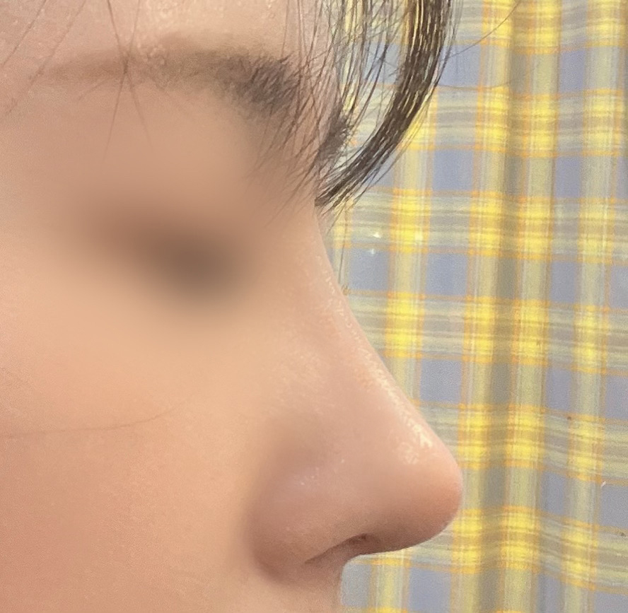 매부리코재수술 후기^---^