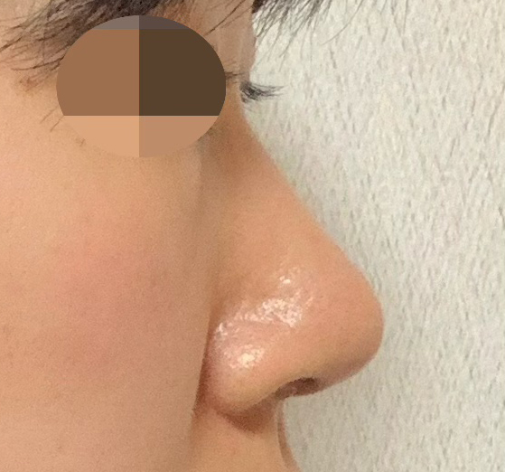 무보형물코수술3달차, 후회없는 수술입니다.