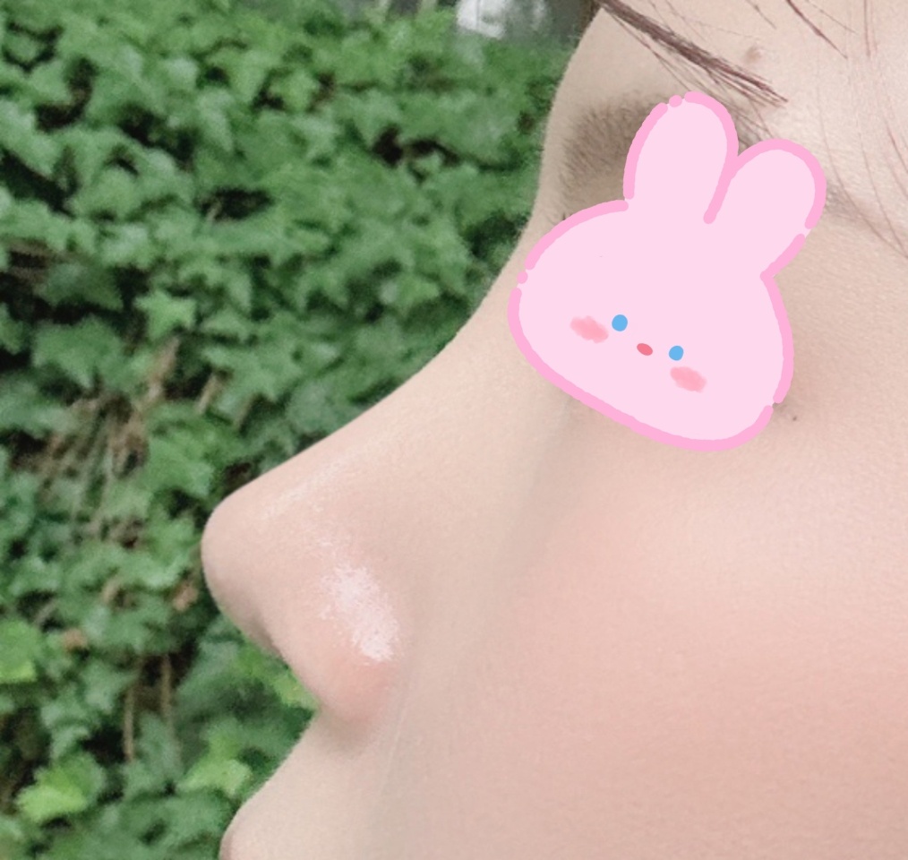 낮고 짧았던 코를 이쁘게 수술해주셨어요><