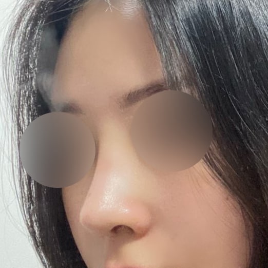 콧대 코끝 수술했어요^^