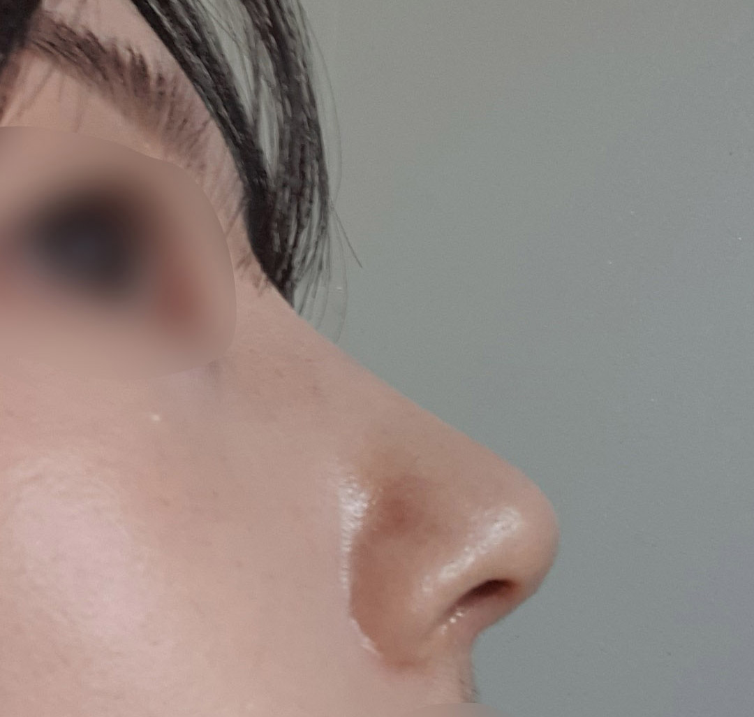 무보형물코수술 대만족입니다:)