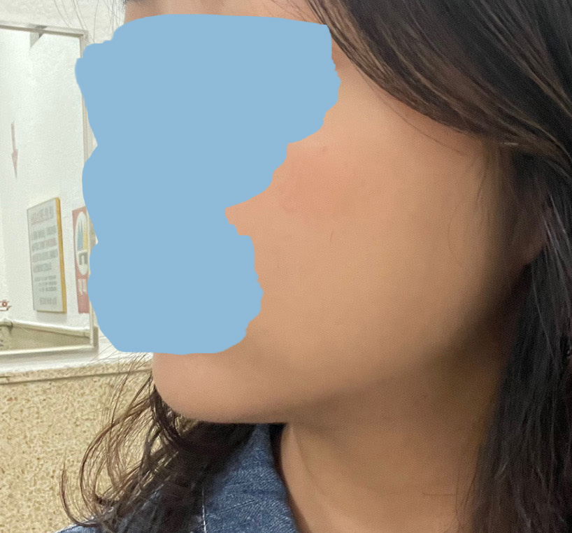 이중턱지방흡입 2달지나고 후기써봅니다~