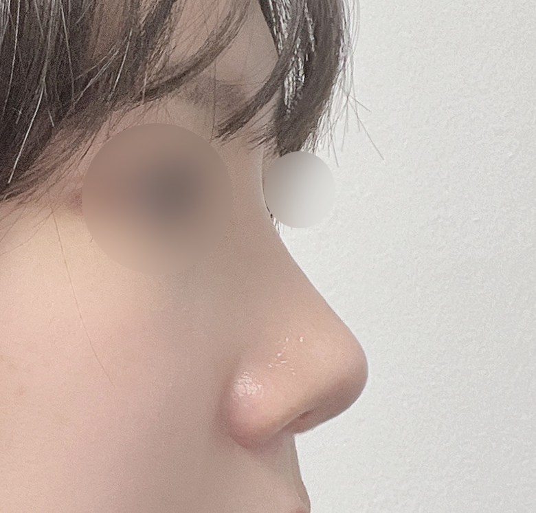 무보형물코성형 삼개월차