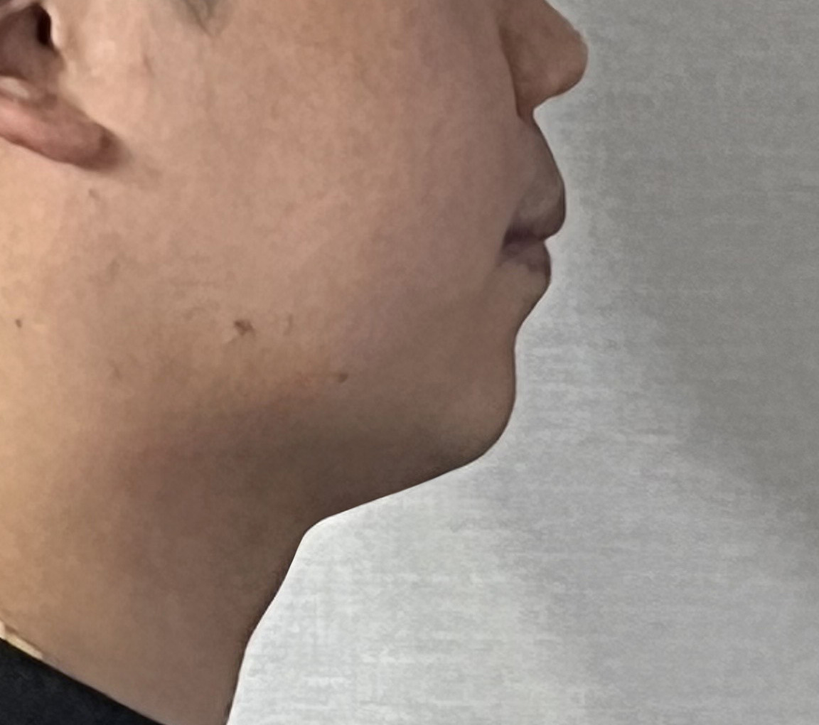 빠지지않던 턱살, 바이브 얼굴지흡으로 없앤 후기