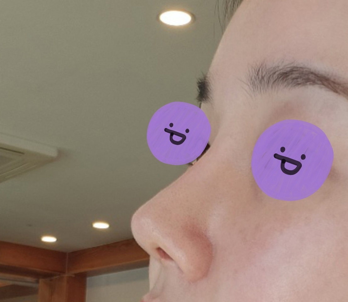 4번째라 더 신중했던 코재수술후기