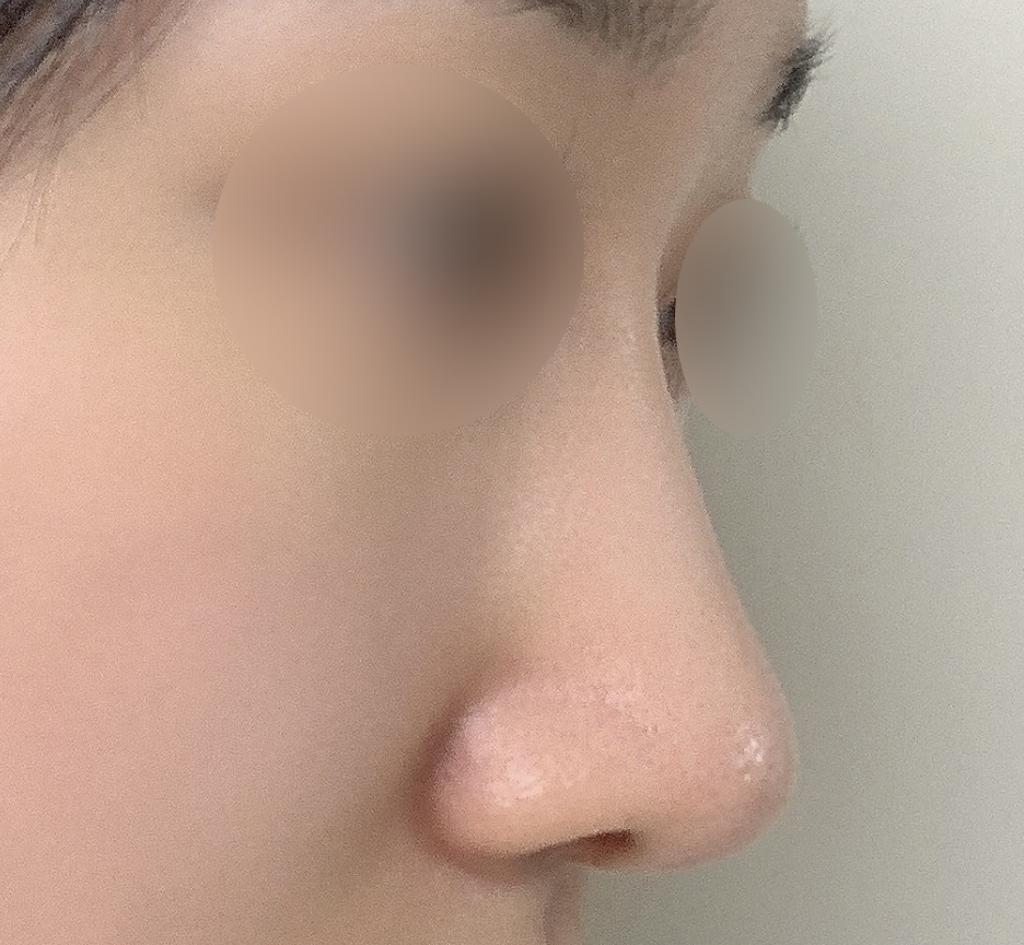 긴코+매부리코성형 3갤차~~