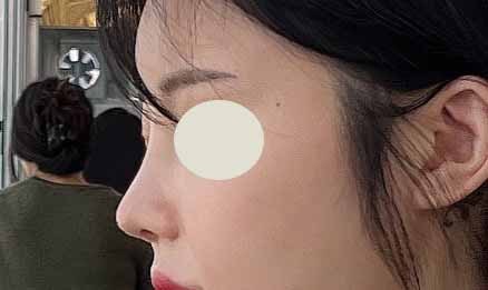 눈,코 재수술 후기!!