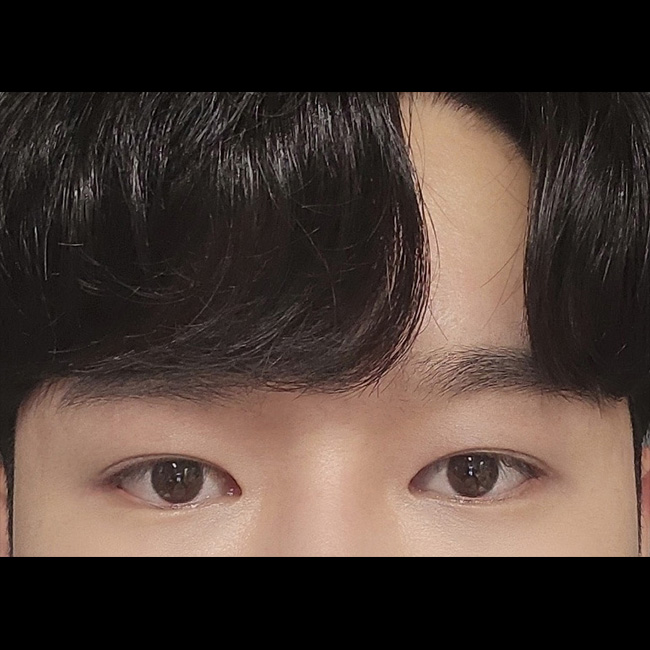 트임성형+이마거상후기 올려요