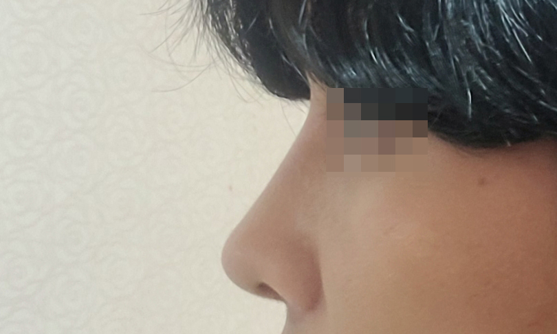 남자기능코, 눈성형 한달차후기올려요