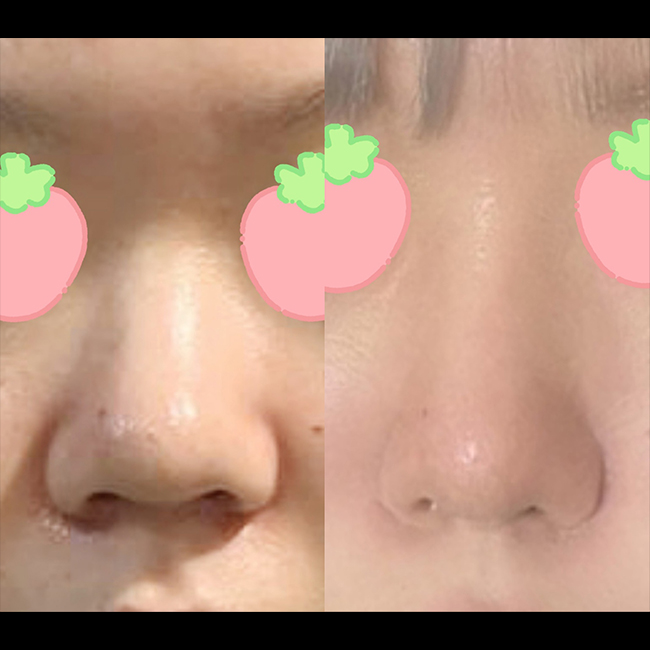 코수술하니 자신감상승했어요~~!