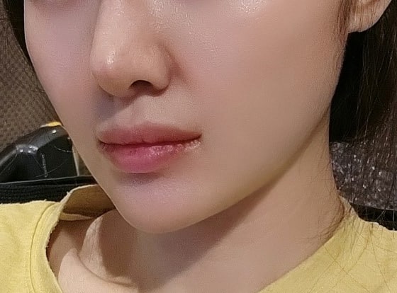 처짐 때문에 마리오넷 흡입했어요~