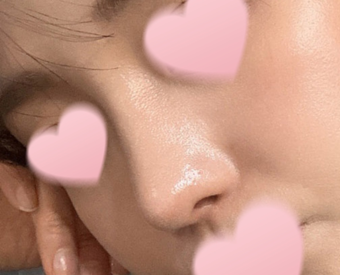 코재수술만 3번째, 성공한 후기