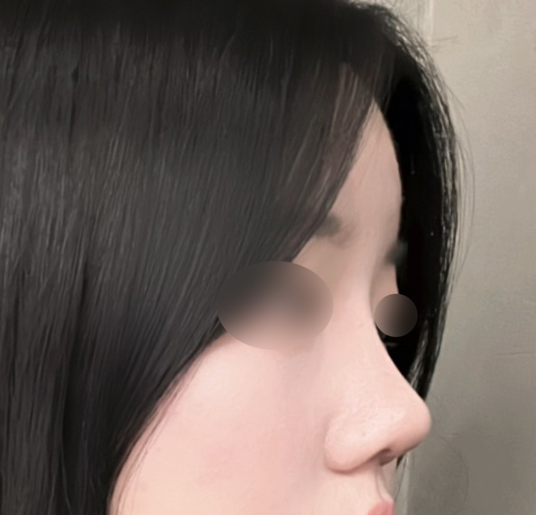 눈/코/지방이식 한달차!!!