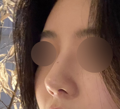 무보형물코성형 알아보신다면 추천드려요:)