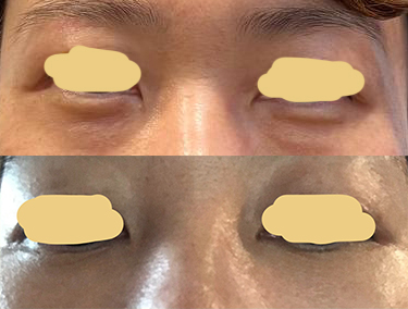 눈밑지방재배치 잘됐어요^^