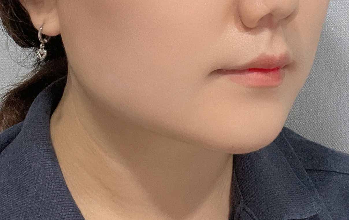 지방흡입+사각턱보톡스 시술 후기