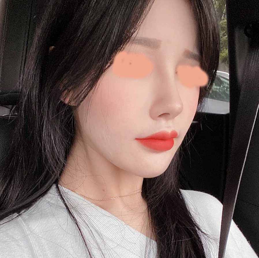 코재수술 얼굴지흡,실리프팅 진짜 만족합니당