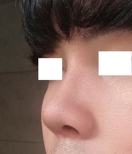 매부리코에서 벗어났습니다!