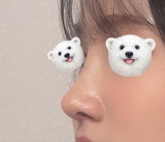 낮은코성형 후기입니당!