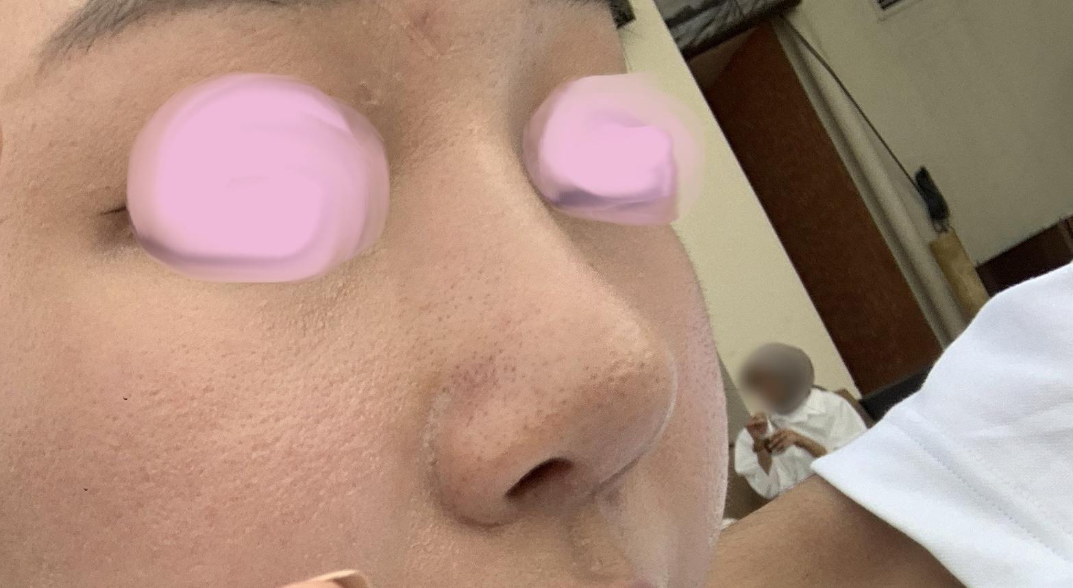 코재수술 정말 만족스럽습니다 ㅎㅎ