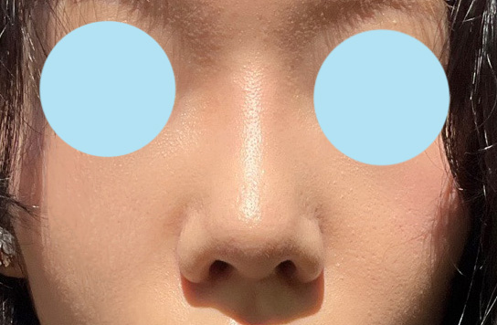 원하던 콧대, 코끝라인으로 나왔슴다!!