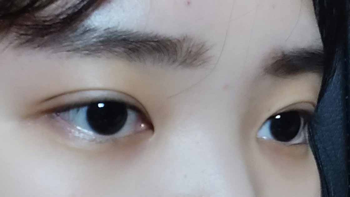 쌍꺼풀 수술 했어용ㅎㅎ