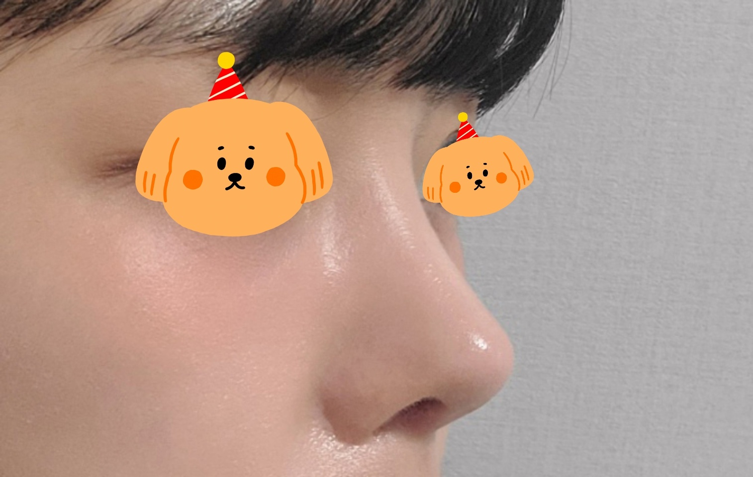 무보형물 코재수술한지 한달지났어요