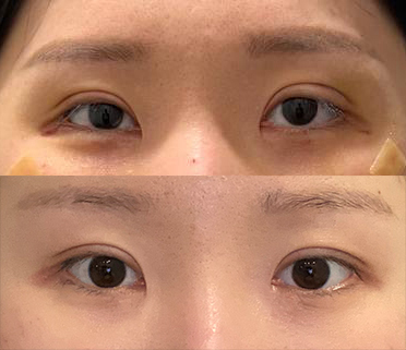 눈매교정 3번째 재수술!