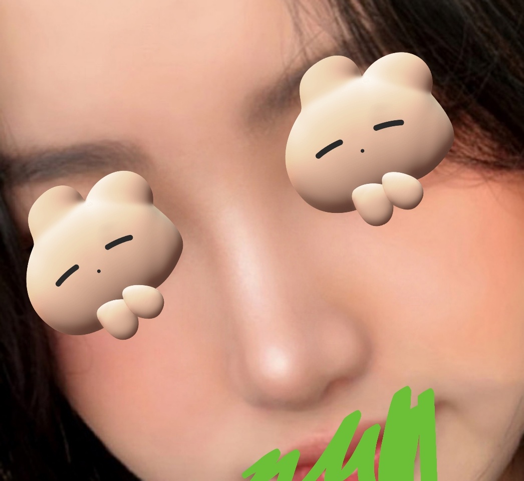 바이브에서 코성형+이중턱지방흡입 받았습니닷~