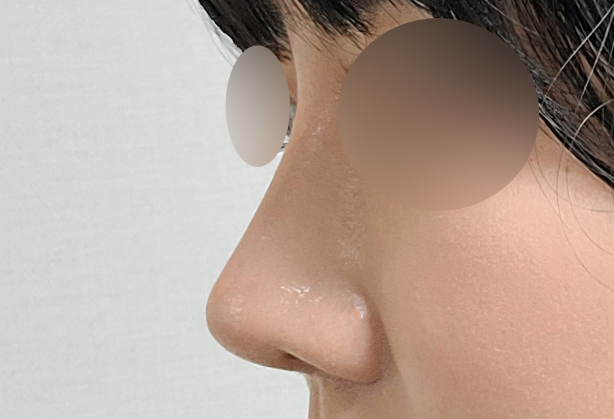 코필러제거후 코수술후기요~!