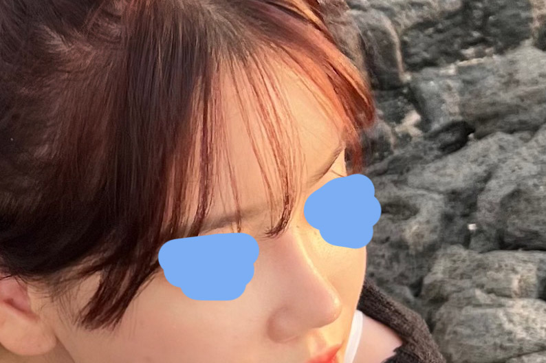 코랑 지방이식 4개월됐어요!