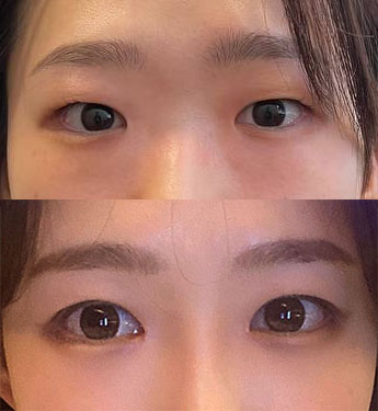 자연스러운 눈 원한다면 바이브추천!