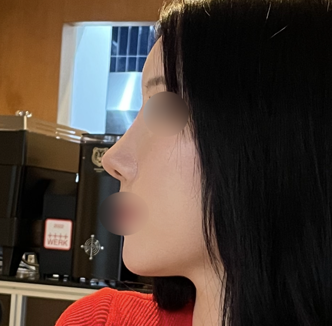 제가 원하던 느낌으로 수술해주셨습니닷!