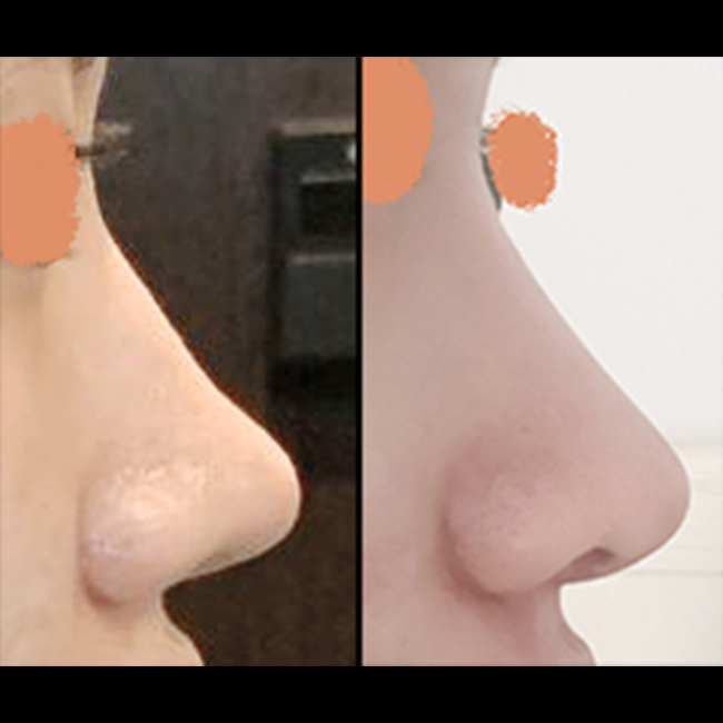 매부리코 코재수술한지 4개월지났습니다아~~