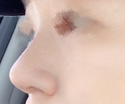 무보형물로 넓은코수술했습니당