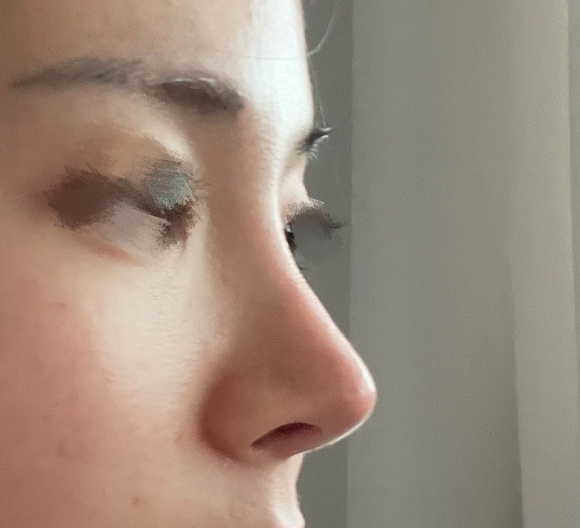 코재수술 바이브 적극추천추천