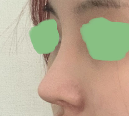 눈, 코 재수술! 바이브에서 하길 잘했습니당