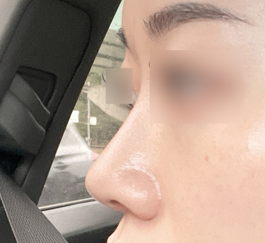 무보형물코성형 잘하시는듯해요 ㅎㅎ 수술 4개월차!