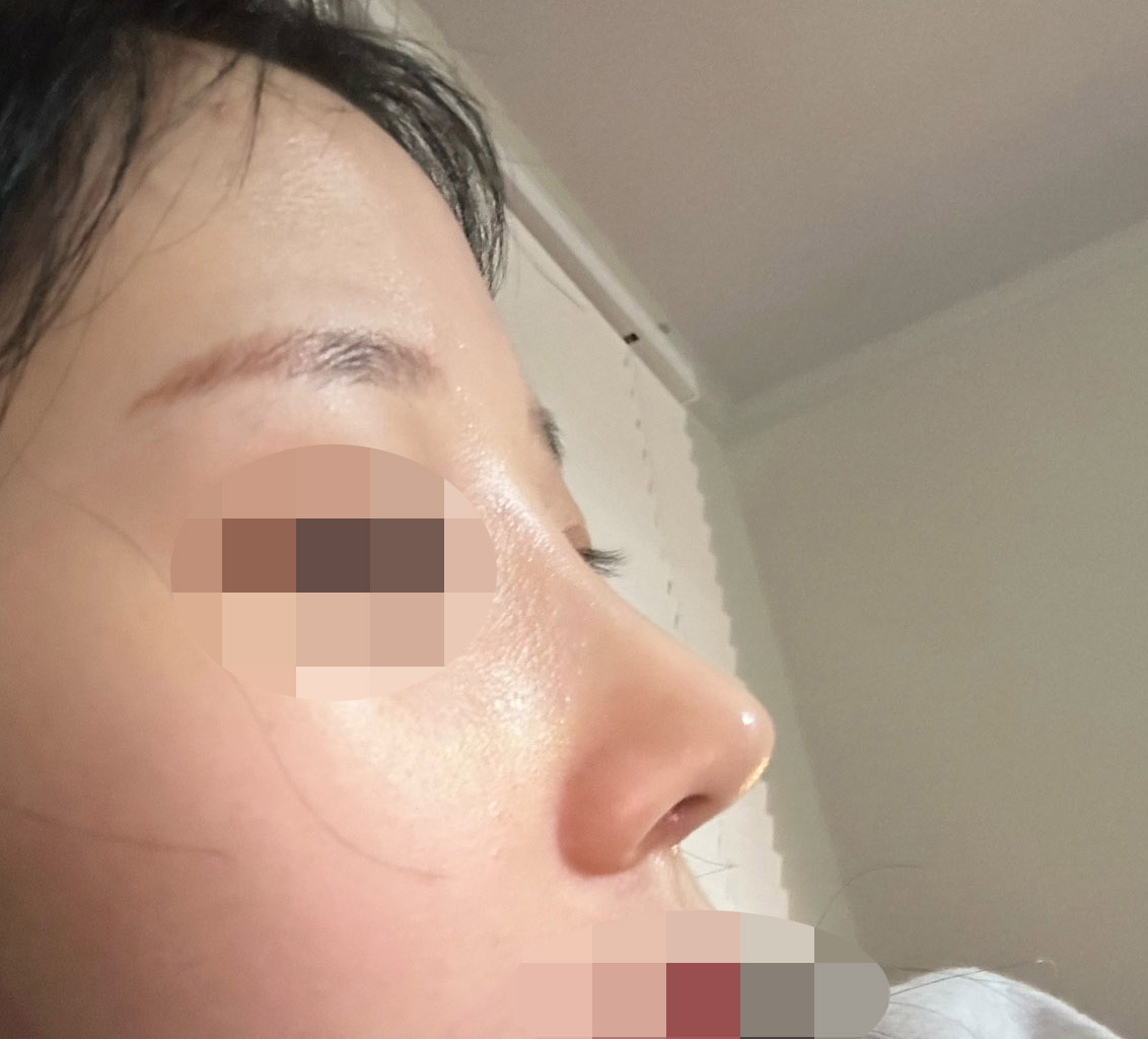 낮은코성형후기!