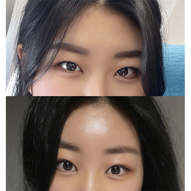 내시경이마거상술, 심부볼제거 한달차됐어용!!