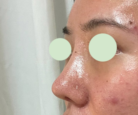 눈,코 받은지 벌써 3주 지나가용