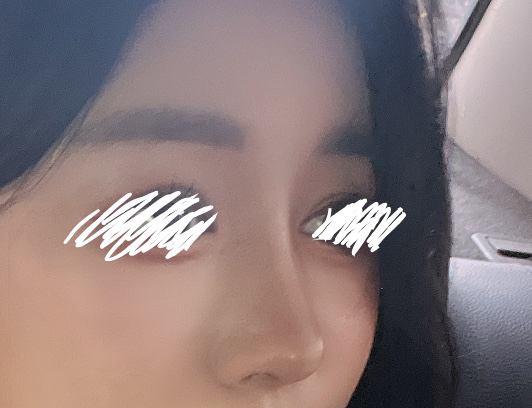 코필러제거후 코수술한 후기:)