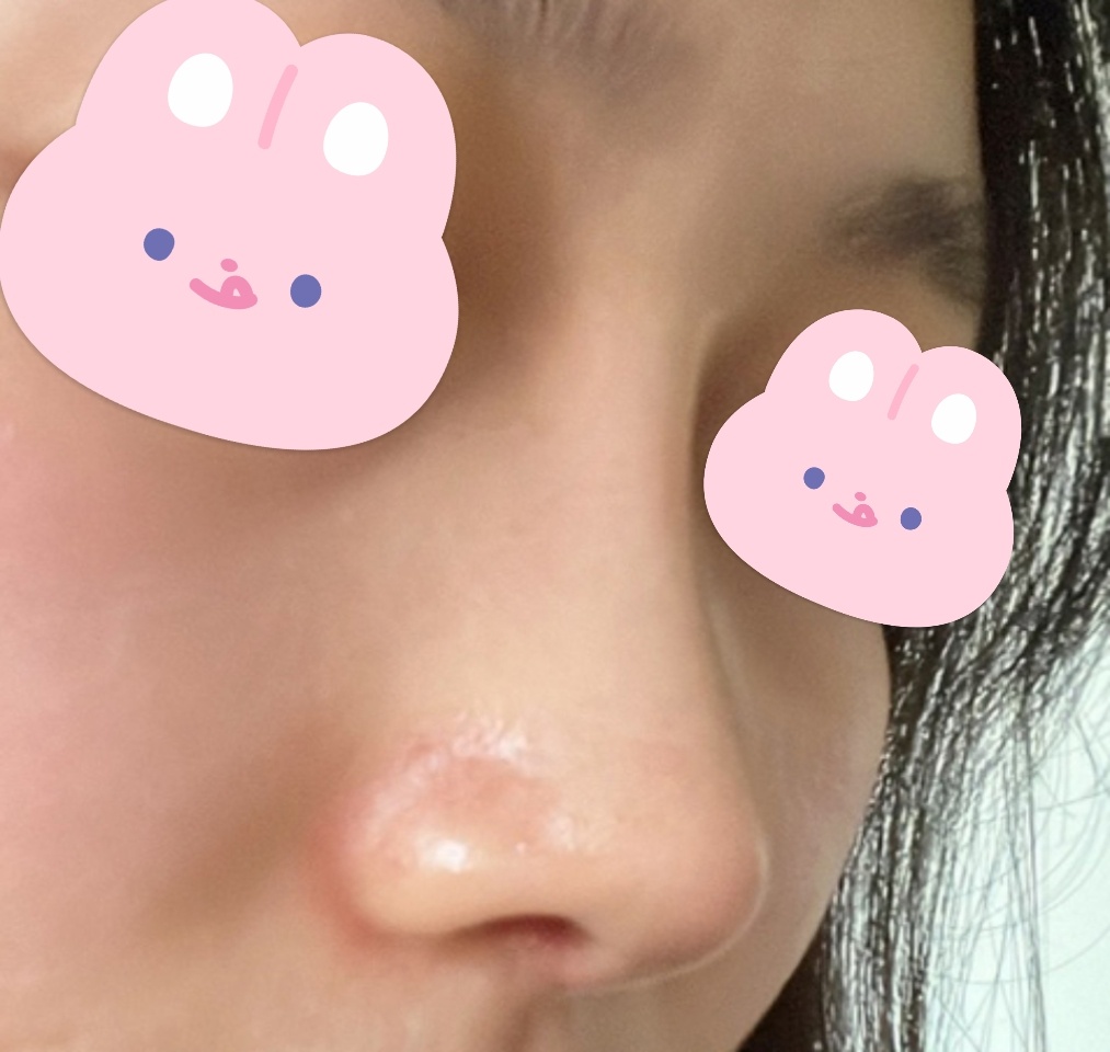 고민했던 코수술, 드디어 하고 만족중입니다